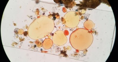 what causes oil in stool