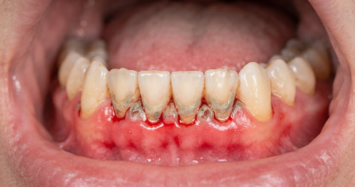 trench mouth causes
